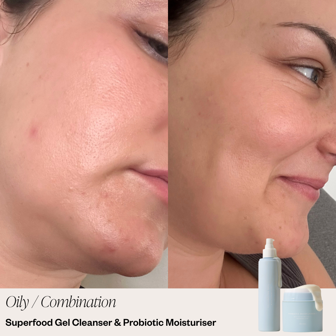 Skin before and after using 2 Step Skincare System showing clearer complexion