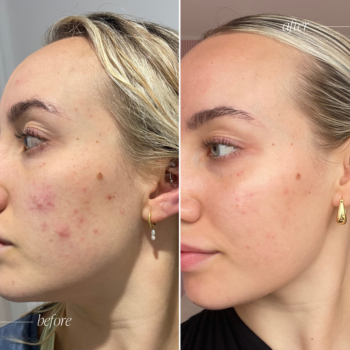 Acne Healer Skincare Trial Bundle