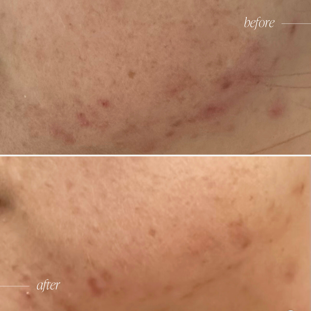 Acne Healer Skincare Trial Bundle