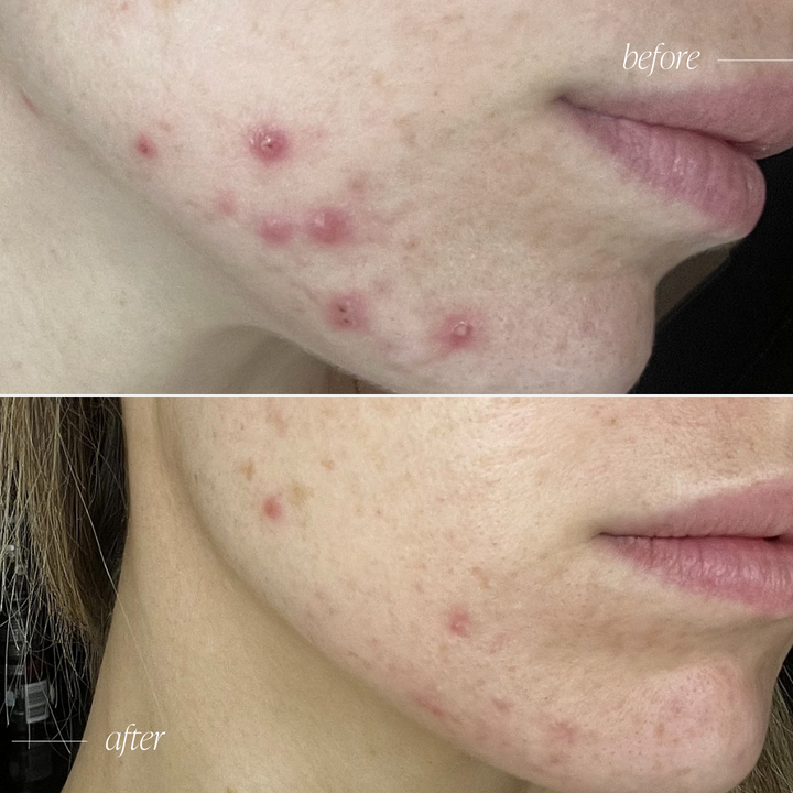 Acne Healer Skincare Trial Bundle