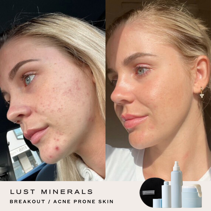 Teen Skincare System