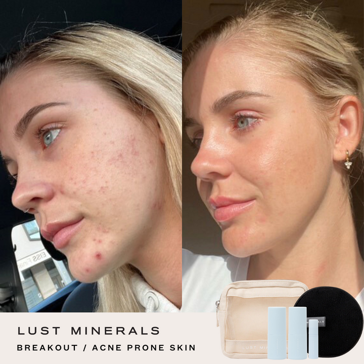 Teen Skincare Trial System