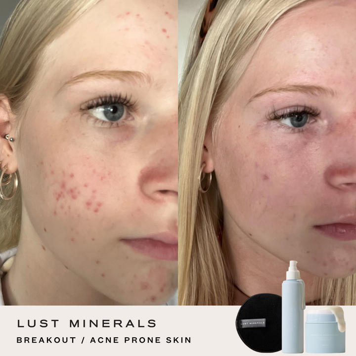 Tween Skincare System