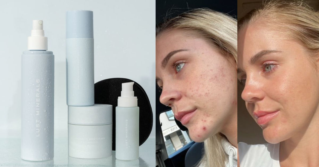 The Best Clean Skincare Products For Acne Prone Skin