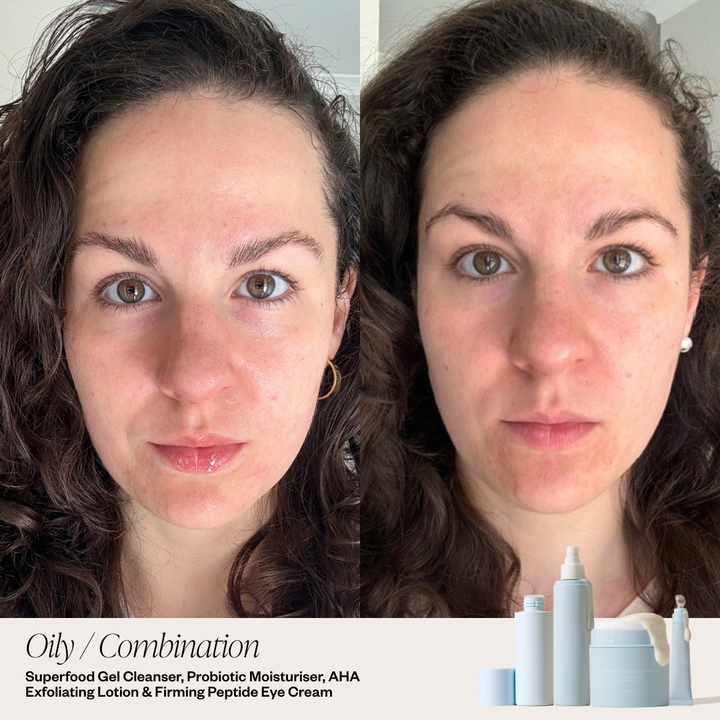 before and after skincare system for clear skin 