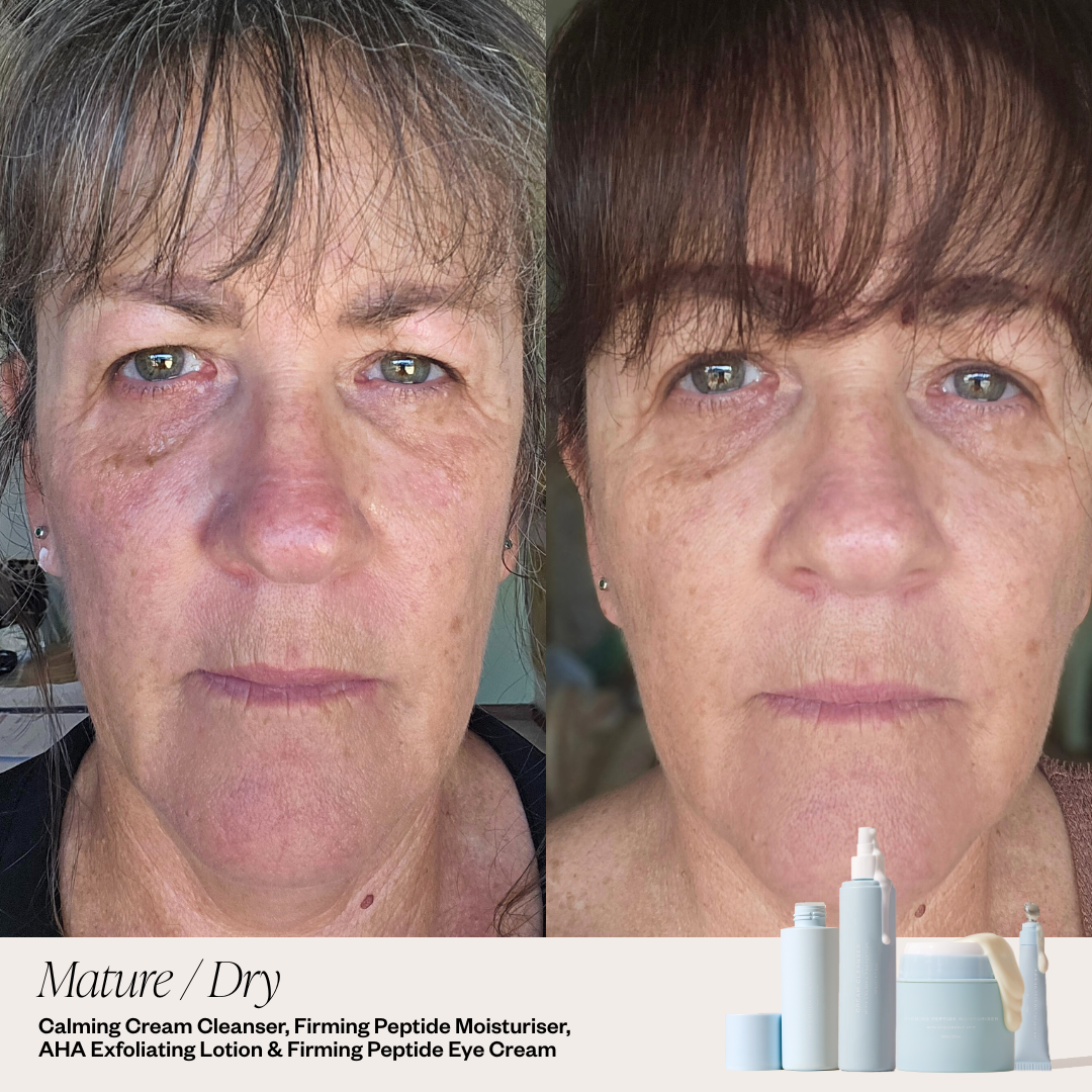 before and after skincare system for clear skin 