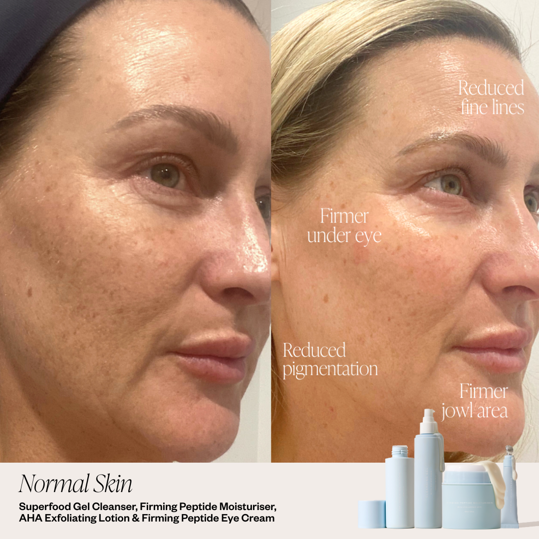 before and after skincare system for clear skin 