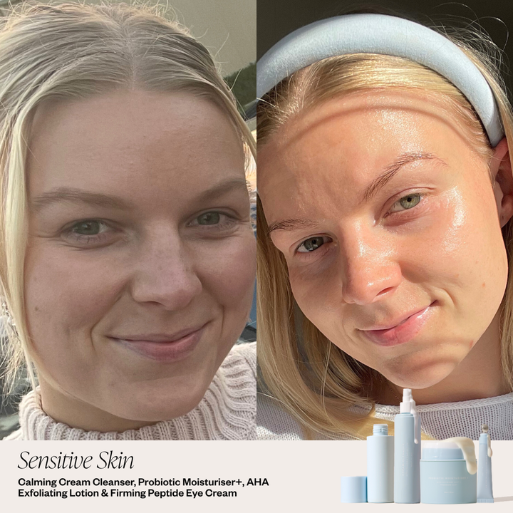 before and after skincare system for clear skin 