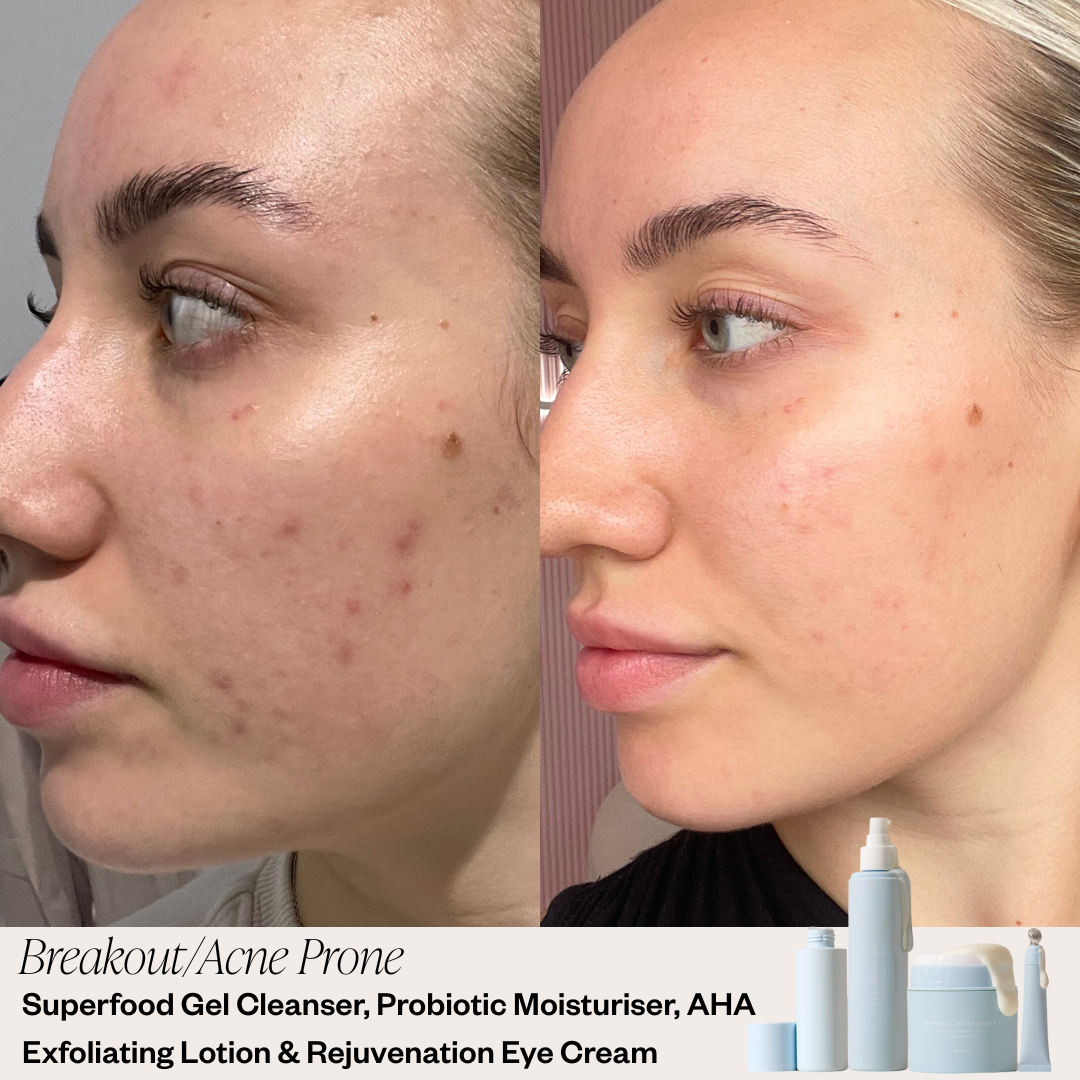 Skin before and after results 
