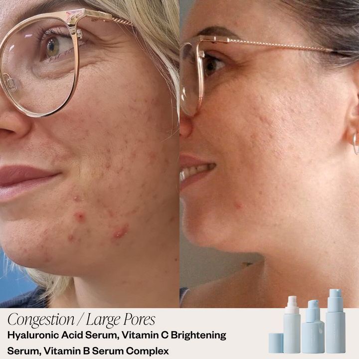 Skin before and after results 