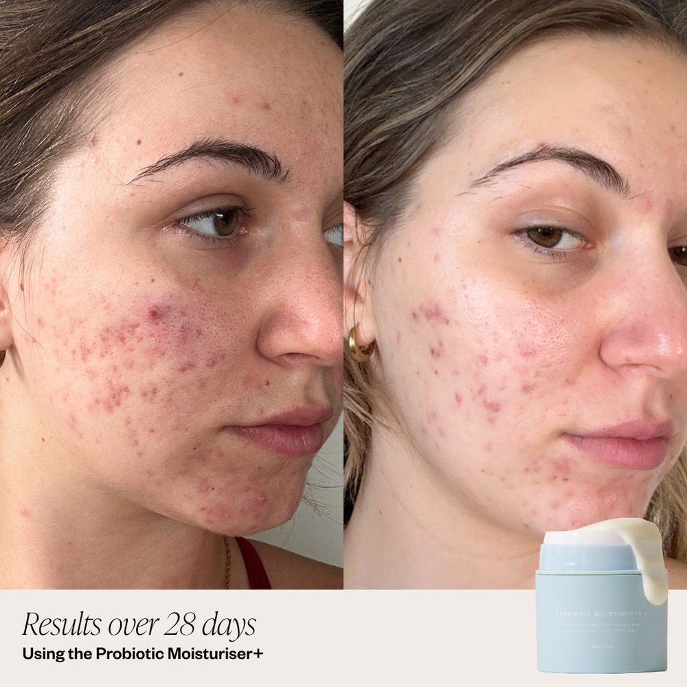 Before and after comparison of a person's face with acne, using a probiotic moisturizer over 28 days.